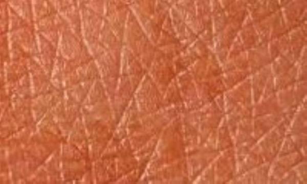 بیماریهایی که روی پوست تاثیر می گذارند بیماریهایی که روی پوست تاثیر می گذارند