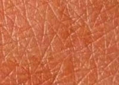 بیماریهایی که روی پوست تاثیر می گذارند