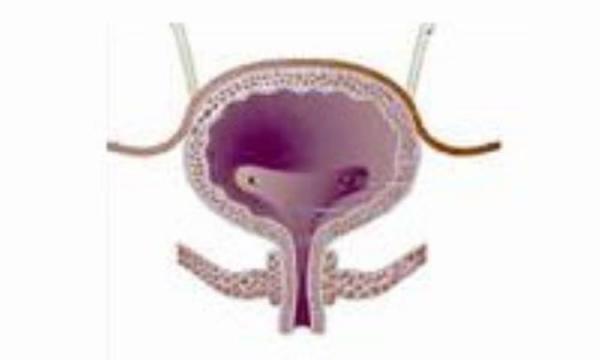 مثانه دیابتی ها در خطر است مثانه دیابتی ها در خطر است