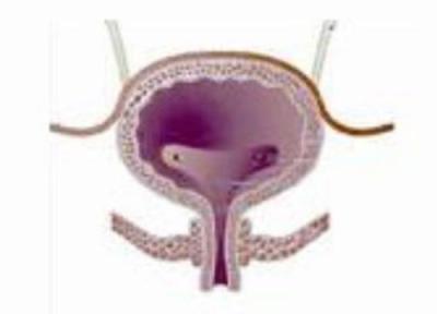 مثانه دیابتی ها در خطر است