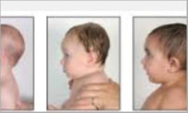 پیشگیری از مبتلا شدن بچه ها به بیماری پلاژیوسفالی پیشگیری از مبتلا شدن بچه ها به بیماری پلاژیوسفالی