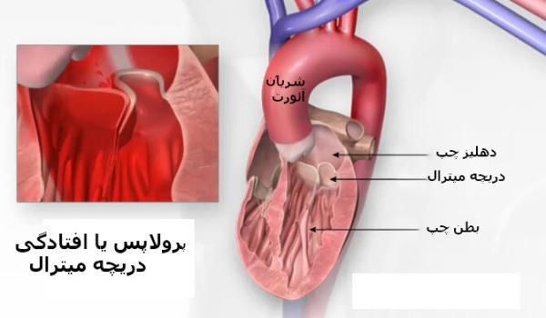 پرولاپس دریچه میترال قلب پرولاپس دریچه میترال قلب