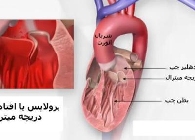 پرولاپس دریچه میترال قلب