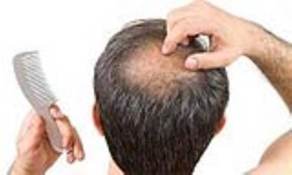 علل بروز آلوپسی اره اتا علل بروز آلوپسی اره اتا