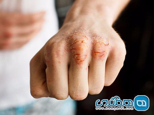 دلایل ترک خوردگی پوست و راه های درمان آن دلایل ترک خوردگی پوست و راه های درمان آن