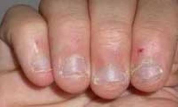 ریشه شدن پوست اطراف ناخن ریشه شدن پوست اطراف ناخن