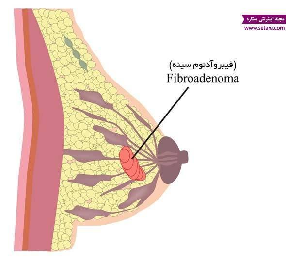 علائم سرطان سینه چیست؟ علائم سرطان سینه چیست؟