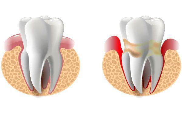 توجیه خونریزی لثه ها در 6 وضعیت توجیه خونریزی لثه ها در 6 شرایط