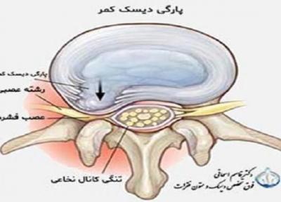 فتق یا پارگی دیسک کمر چیست؟
