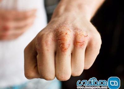 دلایل ترک خوردگی پوست و راه های درمان آن