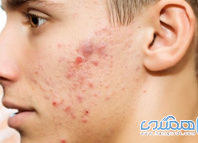 غذاهایی که باعث آکنه می شوند