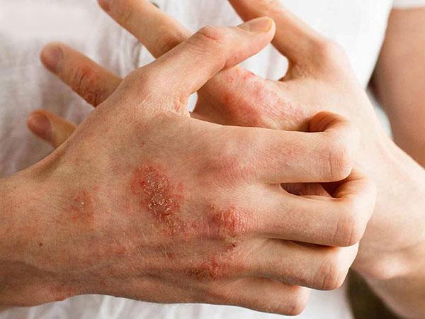 پماد بتامتازون چیست و در چه مورادی تجویز می شود؟ پماد بتامتازون چیست و در چه مورادی تجویز می گردد؟